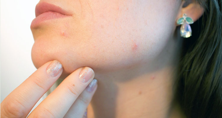 castor oil overnight acne